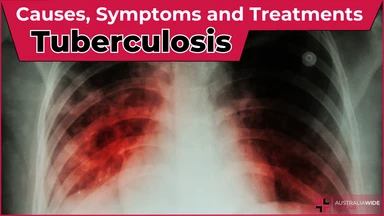 Tuberculosis article header – First Aid Article in Deception Bay